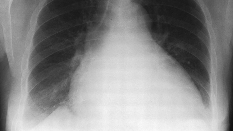 Congestive Heart Failure: A Case Based Discussion Congestive Heart Failure: A Case Based Discussion