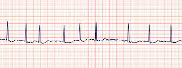 Atrial Fibrillation : A case based Discussion Atrial Fibrillation : A case based Discussion