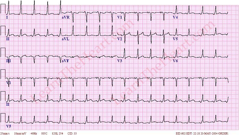 Wolf Parkinsons White Syndrome : A case Based Discussion Wolf Parkinsons White Syndrome : A case Based Discussion