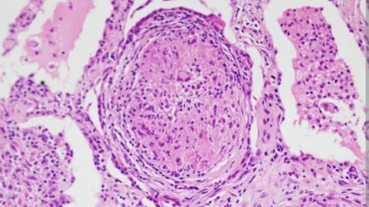 Sarcoidosis : A case Based Discussion Sarcoidosis : A case Based Discussion