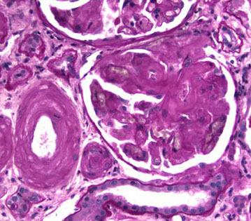 Certificate Course in Amyloidosis : A case Based Discussion Certificate Course in Amyloidosis : A case Based Discussion
