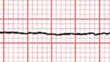 Asystole : Introduction causes symptoms & Management Asystole : Introduction causes symptoms & Management